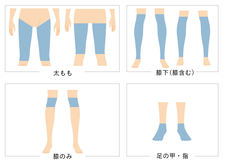 その他パーツ脱毛