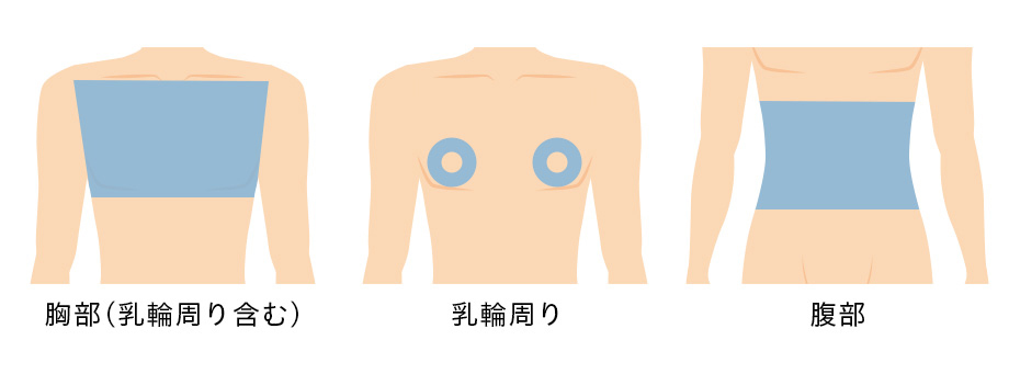 その他パーツ脱毛